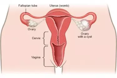 best doctor for pcod treatment in manesar, best gynaecologist for the treatment of PCOS in manesar, polycystic ovarian syndrome pcos, polycystic ovarian disease pcod, cost of pcod treatment in manesar
